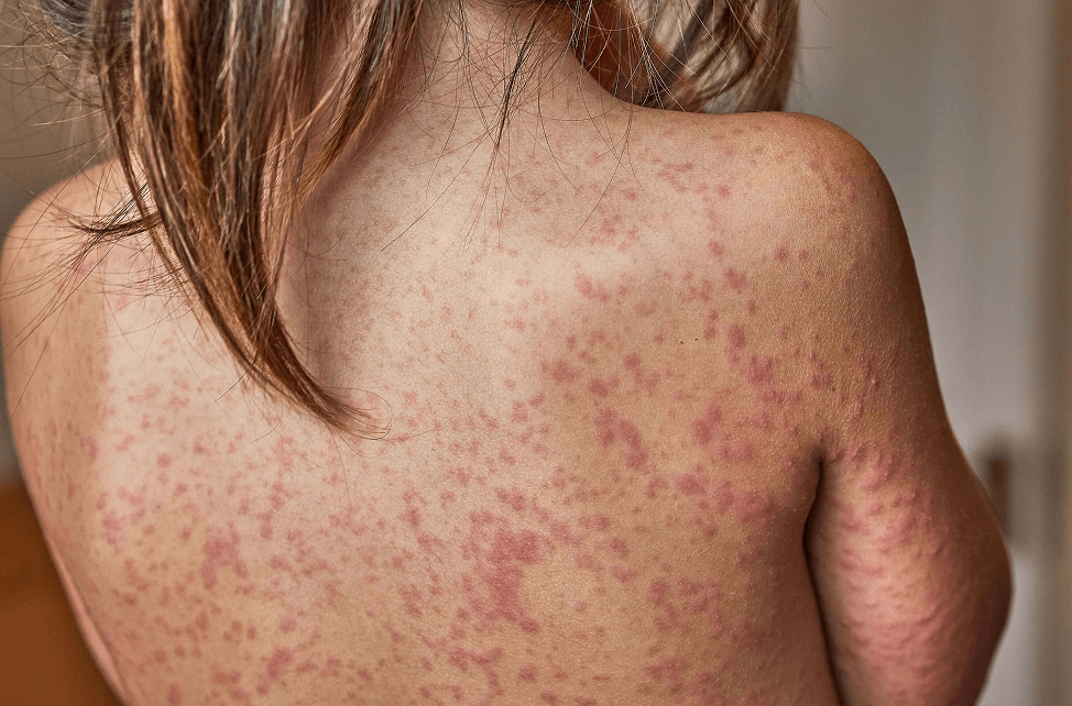 a child’s back covered in a red rash