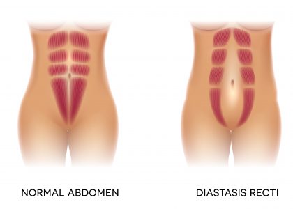 A side by side of "normal" abdomen muscles and muscles with diastasis recti. The image on the right shows a separation of muscle down the middle of the abdomen.