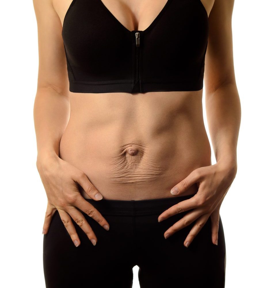 Photo of an abdomen showing a separation of abdominal muscles
