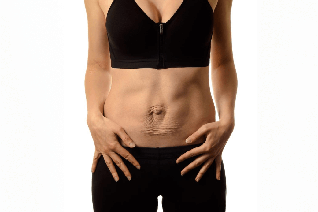 A person’s abdomen showing a visible separation of the abdominal muscles, characteristic of Diastasis Recti.