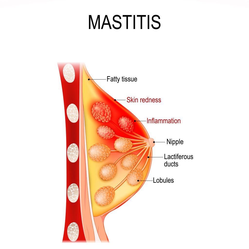 Illustration of mastitis showing an inflamed breast cross-section labeled with fatty tissue, skin redness, inflammation above the nipple, nipple, lactiferous ducts and lobules.