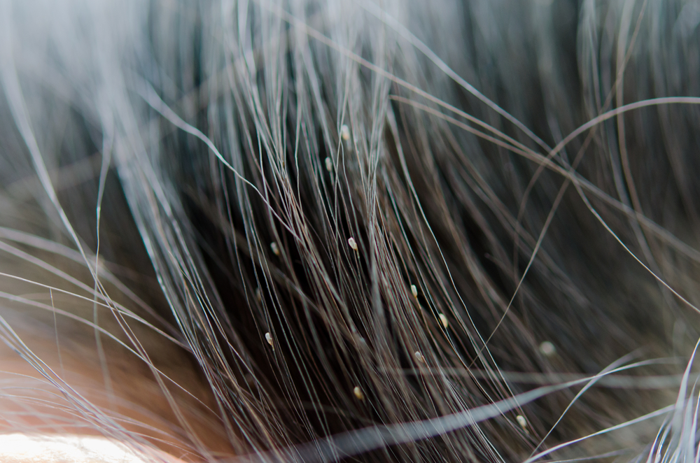 Close-up of a person's hair with lice nits (eggs) on several strands.