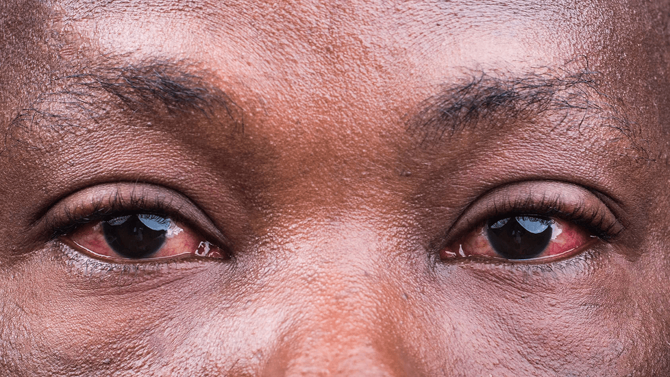 Gros plan d’un adulte dont les yeux sont très rouges