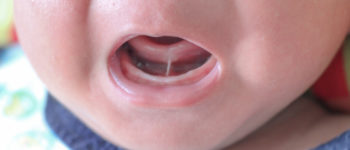 close up of a baby’s open mouth, showing a baby with a tongue tie (a tight piece of skin under their tongue